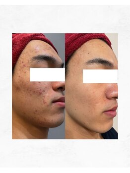 アルル 甲賀(ARuru)/ワンランク上のお肌改善を！