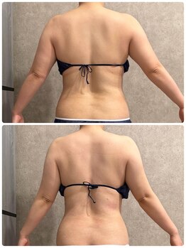 トータルビューティー ミミ(Total Beauty mimi)/脱！ハミ肉♪