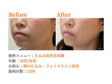 シルエラバレ(CiruelaValle)/Before After