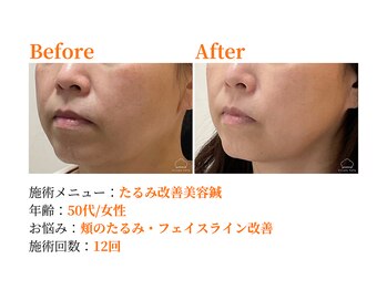 シルエラバレ(CiruelaValle)/Before After