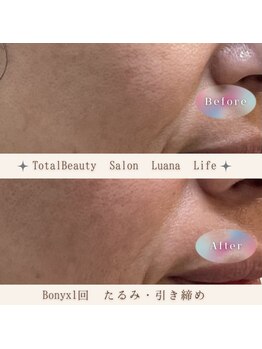 ルアナライフ(Luana Life)の写真/切らずに、無理なく。大人のための最新韓国たるみケア☆目元・口元・フェイスラインに。結果重視の方に!!
