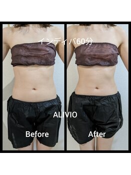 アリビオ(ALIVIO)/妊活インディバ