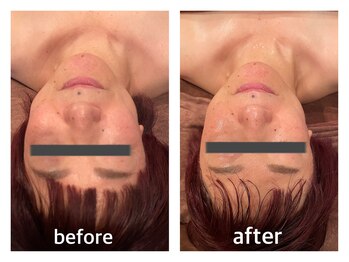 ハリキュア(H.a.r.i C.u.r.e.)/小顔マッサージ・ヘッド