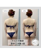 カラー(CALLA)/ウルトラ痩身！背中・二の腕