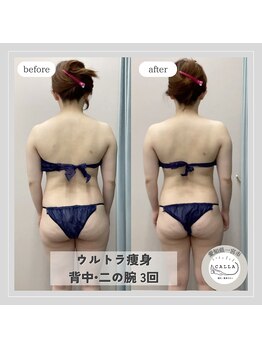カラー(CALLA)/ウルトラ痩身！背中・二の腕