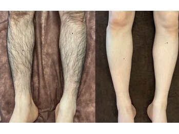 ルルトウキョウ 池袋店(LULU.tokyo)/ひざ下脱毛/1回目→13回目