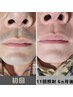 【9月限定】お問い合わせ多い【Oライン＋ヒゲ脱毛】　￥22,000→￥6,600