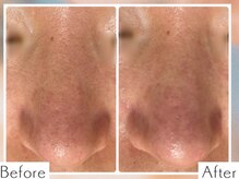 ディオーネ 上越南高田店(Dione)/毛穴洗浄＆毛穴吸引