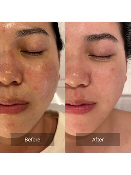 マインエム(mine.m)/繰り返しニキビ・跡・シミ