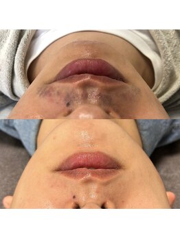 スピカ(Spica)/spicaの光ヒゲ脱毛☆