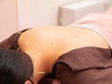 ハリマイルーム(HARI MY ROOM)/全身鍼灸