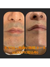 リアンジュ/髭脱毛の経過