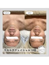 カラー(CALLA)/神の手マシンフェイシャルケア