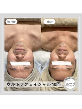 カラー(CALLA)/神の手マシンフェイシャルケア