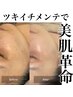 【シミ改善/小顔/毛穴】徳島唯一シミ改善に特化した連射式光フェイシャル
