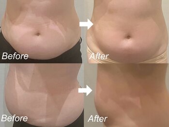 リブラ(LIBRA)/1回60分で驚きの減り具合