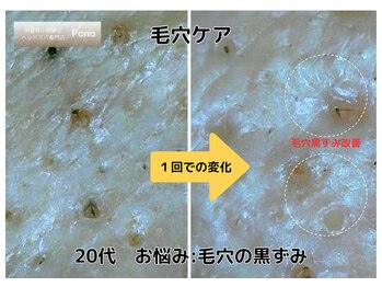 ポノ 甲府本店(pono)/毛穴にょきにょき