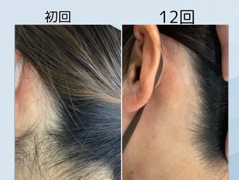 エリクサー 加須店(Elixir)/濃い毛ほど効果がわかる!?