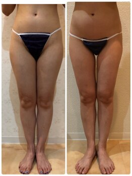 カロン(Kalon)/下半身痩せ