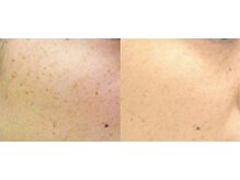 パウザ(PAUSA)/フォトRFフラクショナル