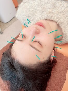 ヒーリングサロン アージュ(A-je)/★美顔鍼＋小顔矯正★