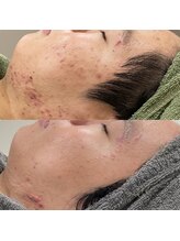 エクシアホワイトニング 碧南店/《オプション》CYリキッド