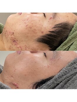 エクシアホワイトニング 碧南店/《オプション》CYリキッド