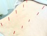 【慢性的なお身体の痛み・不調・気怠さに】☆全身鍼灸×根本改善整体☆　