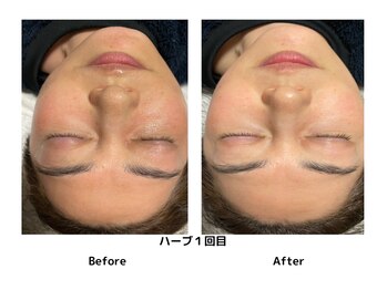 レミューズ(LES MUSES)/ハーブピーリング／生酵素