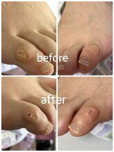 フロー(Froh)/第5趾のウオノメの原因