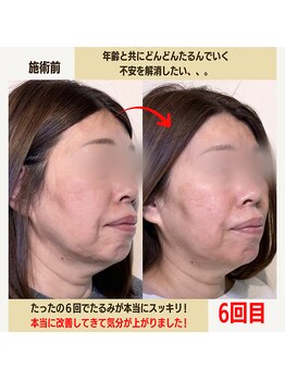 経堂鍼灸整体院/幹細胞美容鍼+小顔矯正