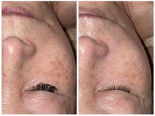 【脱毛・よもぎ蒸しサロン】Quokka/光フェイシャル