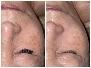 【脱毛・よもぎ蒸しサロン】Quokka/光フェイシャル