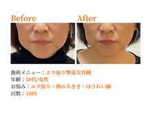 シルエラバレ(CiruelaValle)/Before After