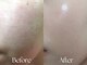 オリーブ ミィ(Olive 美)の写真/韓国で話題沸騰のハーブピーリングを体感◇肌のお悩みを徹底改善♪毛穴・ニキビケアに◎ハリのある艶肌へ+*