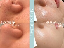 メゾンリュバン 梅田店(Maison Ruban)の雰囲気（ララピール【ニキビケア/毛穴洗浄/ひらき毛穴/シミケア】）