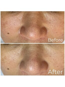 ウエカ(ueka)/脱マスクの前に毛穴ケア