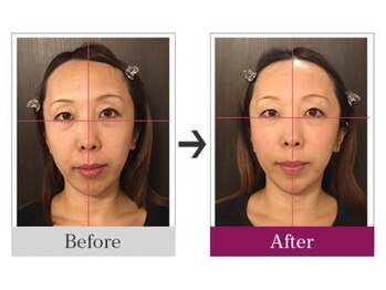 ビコツゼロ 心斎橋(BIKOTSU ZERO)/小顔・目の高さ・口角の高さ