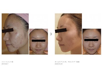 ビューティーサロンレモン(Lemon)/芸能人ピーリング