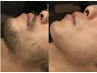 【何回でも同価格】顔WAX脱毛3パーツ(おでこ、鼻、鼻下)￥3000 回数：1回