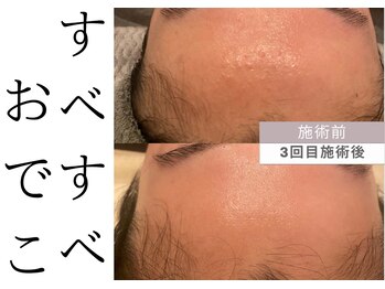 チッチ アフロディーテ(Chicchi Aphrodit)/ハーブピーリング