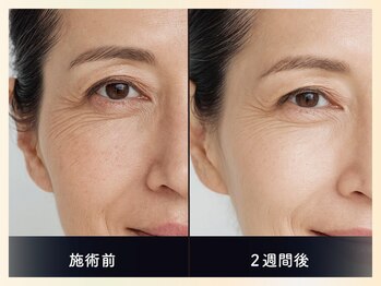 ソウナ(SONA)/ララピール上位版☆ダクトピール