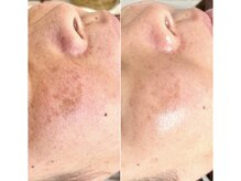 イロドリ(irodori)/エクソソームハーブピーリング♪