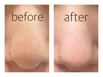 ペルボヌール 深井店/毛穴洗浄（ハイドラ）