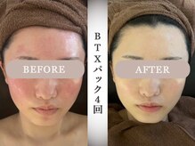 モルティー 宇都宮東店(Molti)/肌質改善/引き締め/小顔矯正/BTX