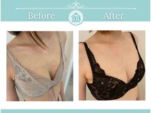 美人バスト 本厚木店/バストアップ◇症例◇