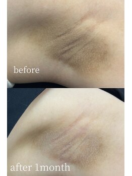 ラミパス(LAMIPAS)/ローマピンク　症例　脇1ヶ月