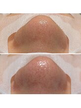 ノーブル 上土店(Noble)/毛穴洗浄BeforeAfter