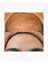 アルル 甲賀(ARuru)/1回でエステ10回分の効果！