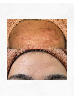 アルル 甲賀(ARuru)/1回でエステ10回分の効果！